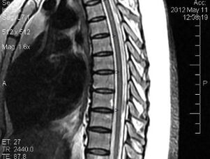 MRI van de thoracale wervelkolom