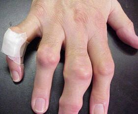 vingers met gewrichtsmisvormingen veroorzaken pijn