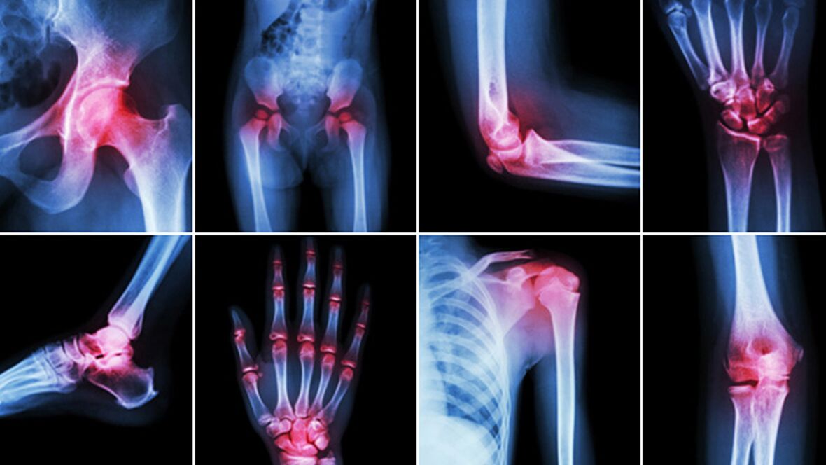 Röntgenfoto's voor gewrichtspijn