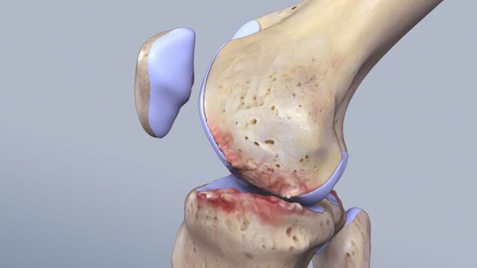 De structuur van het kniegewricht beïnvloed door pathologie