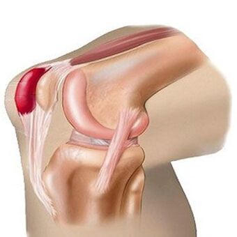 Een van de oorzaken van pijn in het kniegewricht is bursitis. 