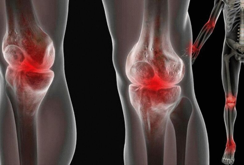 Pijn in de gewrichten van de armen en benen veroorzaakt door verschillende ziekten