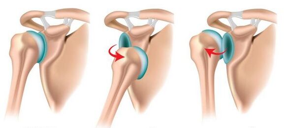 Anterieure en posterieure dislocatie van het schoudergewricht, wat de ontwikkeling van artrose veroorzaakt