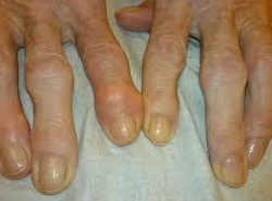 Artrose van de kleine gewrichten van de handen
