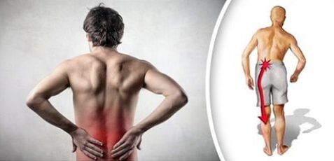 Pijnsyndroom met lumbale osteochondrose straalt naar de benen