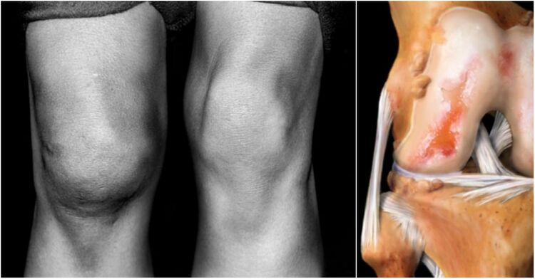 Arthrose van het kniegewricht en het pijnlijke gewricht