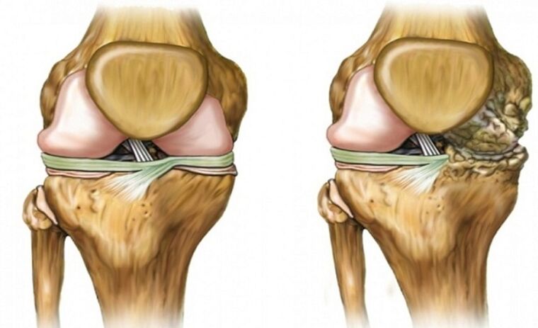 Gezond en getroffen door arthrose -gewricht