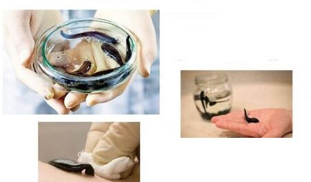 hirudotherapie voor artrose